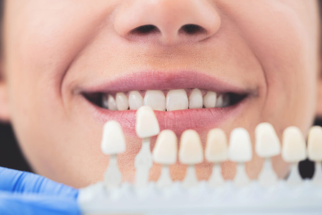 blanqueamiento dental en consultorio, tratamiento para blanquear los dientes, blanqueamiento dental profesional