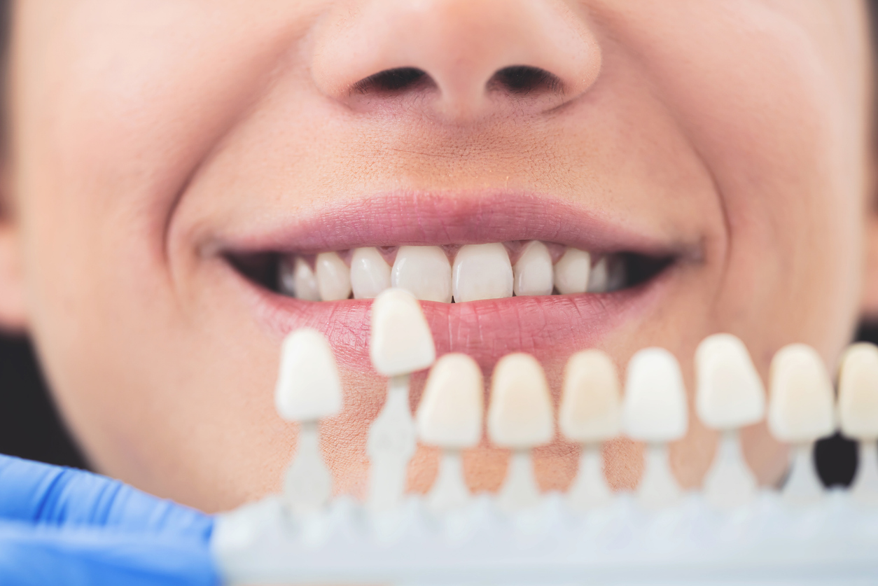 blanqueamiento dental en consultorio, tratamiento para blanquear los dientes, blanqueamiento dental profesional